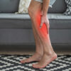Leg Clots (DVT): An Immediate and Long-Term Health Risk